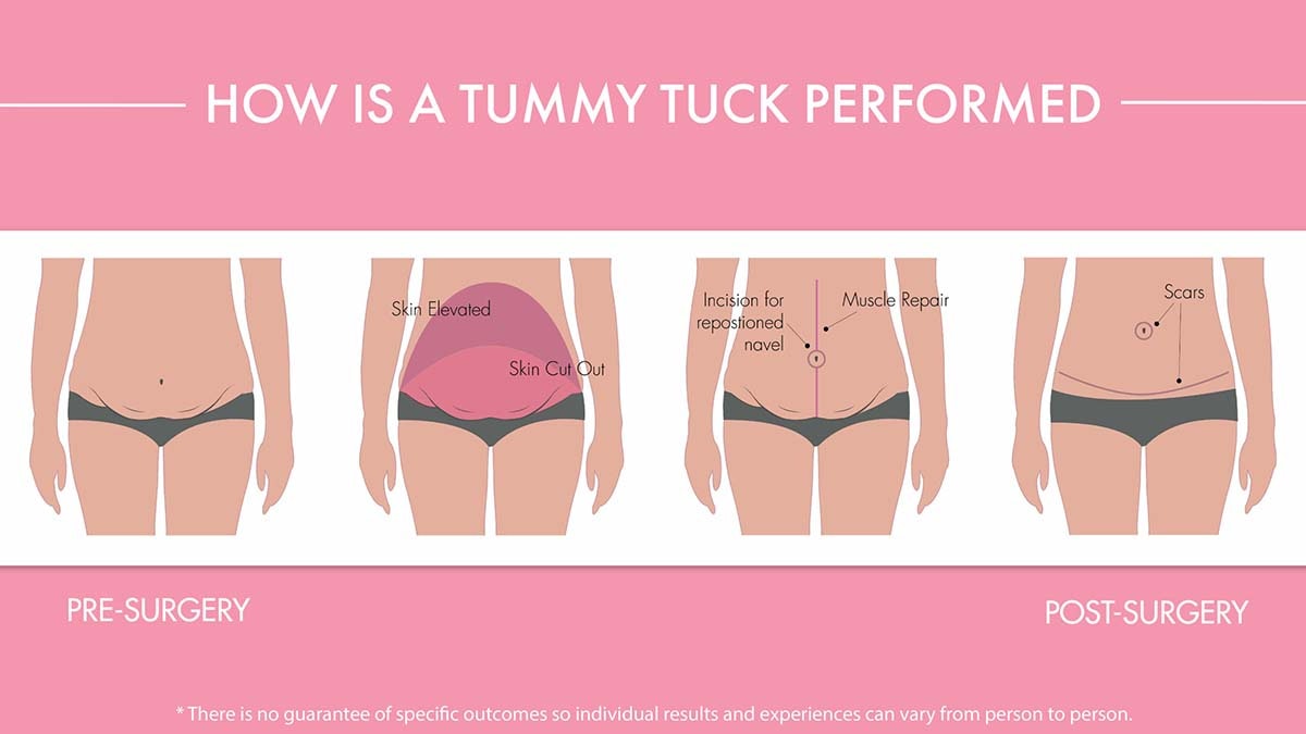 Tummy tuck procedure diagram