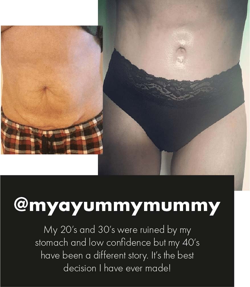 Tummy tuck patient story