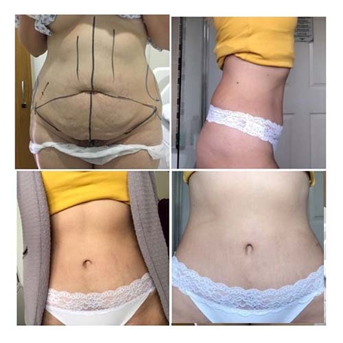 Tummy tuck patient story