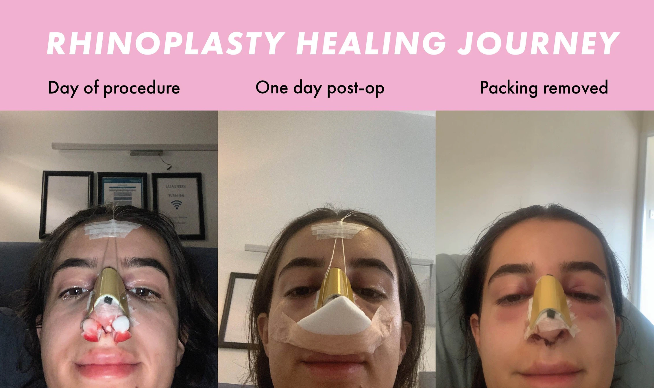 Rhinoplasty swelling: The stages of recovery | MYA Cosmetic Surgery
