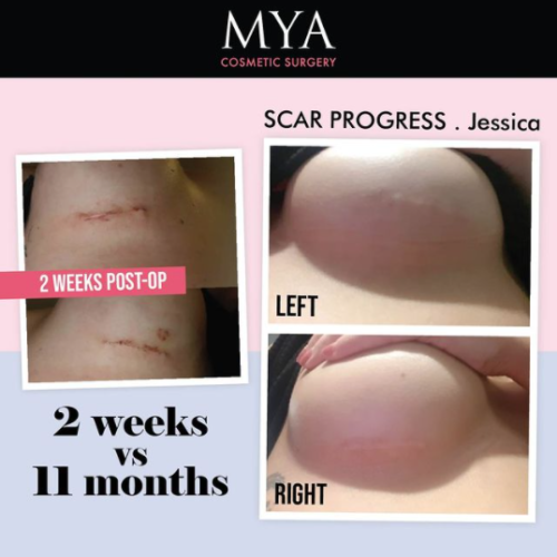 Breast Surgery Scarring Guide